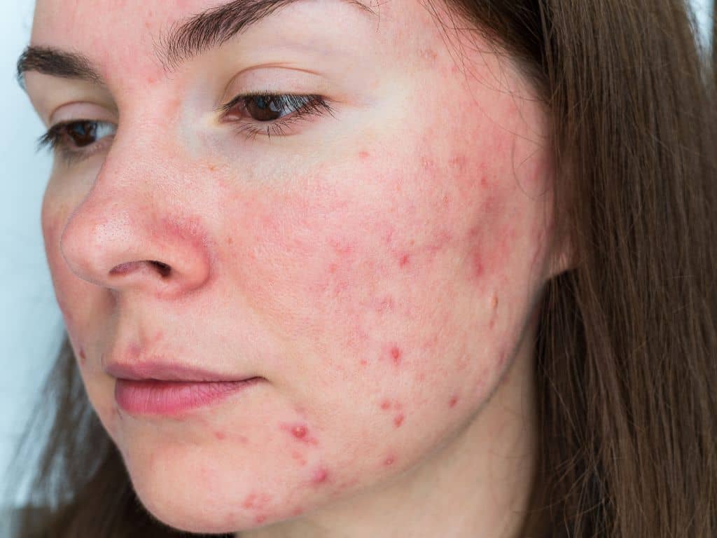 Differenza tra acne e rosacea